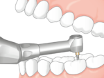 NSK Endo-Mate TC2 - Image 2