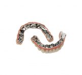 JD Metal Full-Arch Rehabilitations