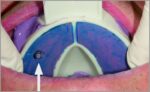 HAGER & WERKEN Miratray Implant kašike - Image 4
