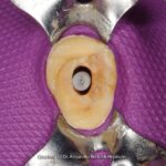 DENTSPLY RTD Macro-Lock Oval fiber kočići - Image 3