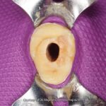 DENTSPLY RTD Macro-Lock Oval fiber kočići - Image 2